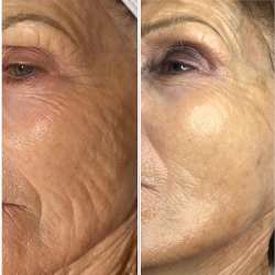 before and after picture of a woman and procell microchanneling treatment showing tighter skin