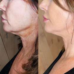 woman showing chin fat loss due to cryoslim treatment
